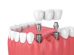 The Role of Dental Implants in Boosting Self-Expression Through Smiles